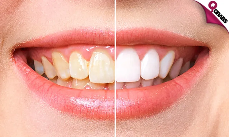 Teeth Whitening + Consultation!